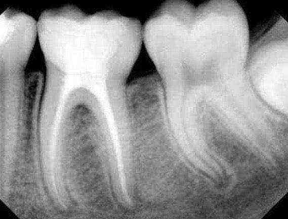 Endodoncia
