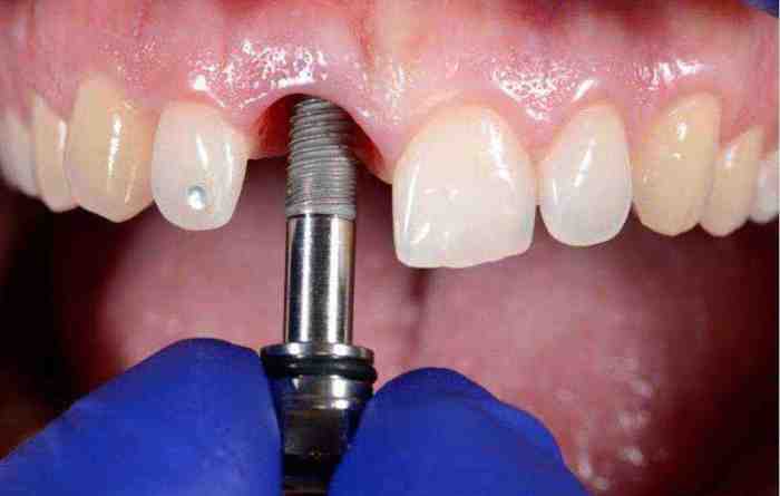 Implantes